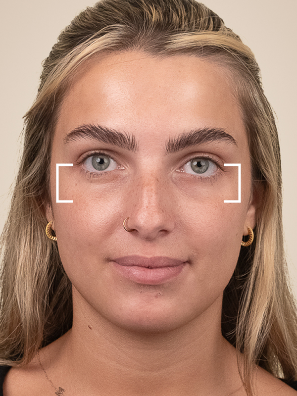 Tear Trough Filler